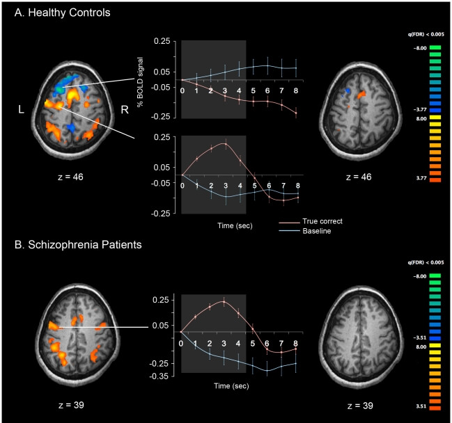 fMRI brain scan of schizophrenic patient and control